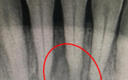 Cureus | Management of Acute Periodontal Abscess Mimicking Acute Apical