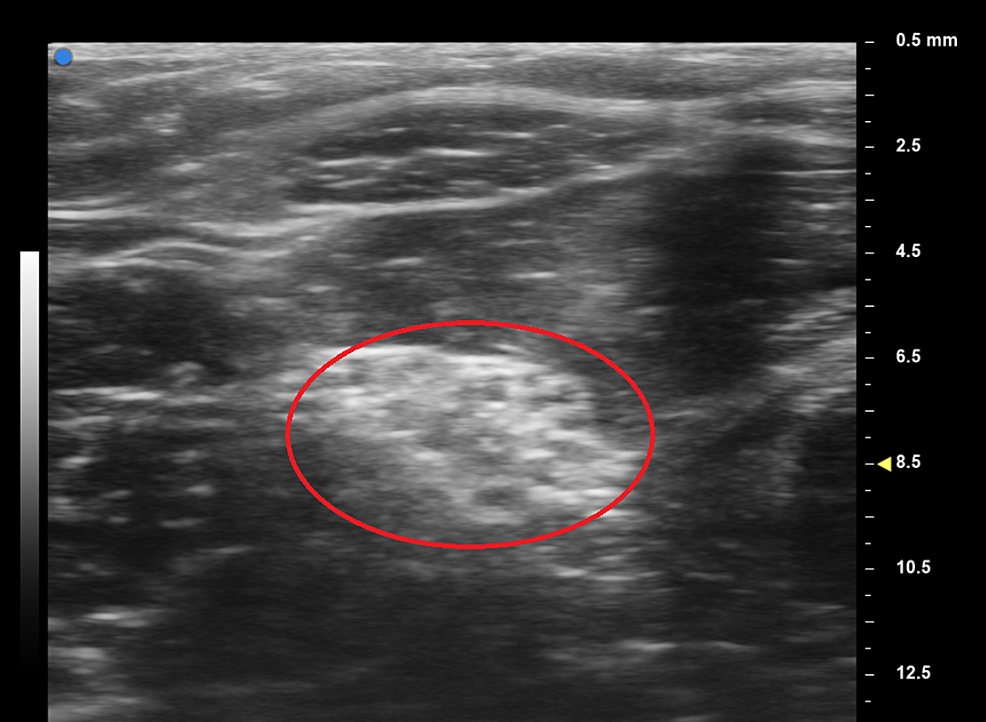 Cureus Use of Ultrahighfrequency Ultrasound on Diagnosis and
