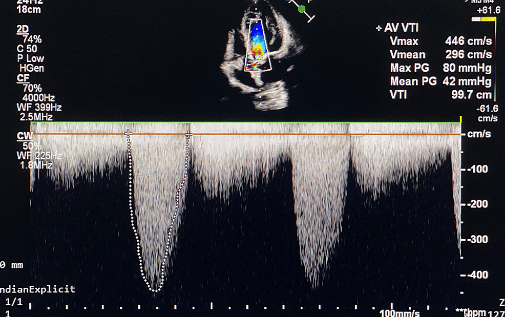 Unraveling the Trio of Interrupted Descending Aorta, Aortic