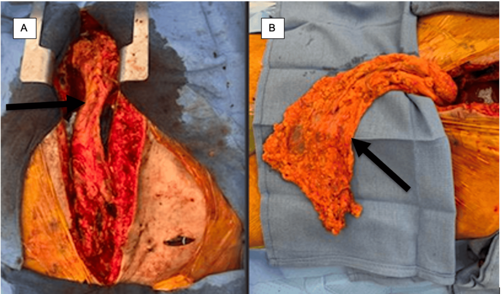 The Use of an Omental Flap in the Management of Complex Thoracic Aortic Infections