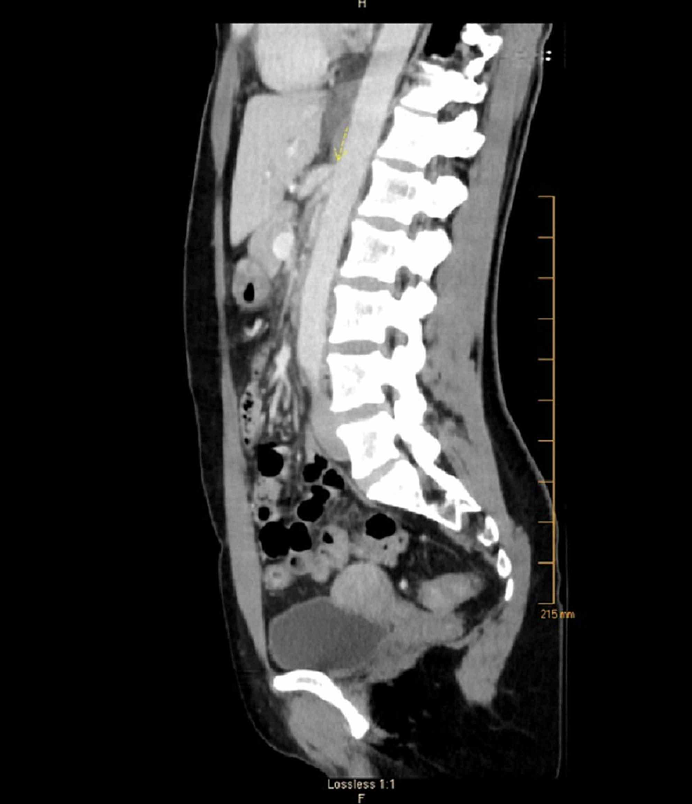 Cureus Celiac Artery Compression Syndrome A Unique Pr - vrogue.co