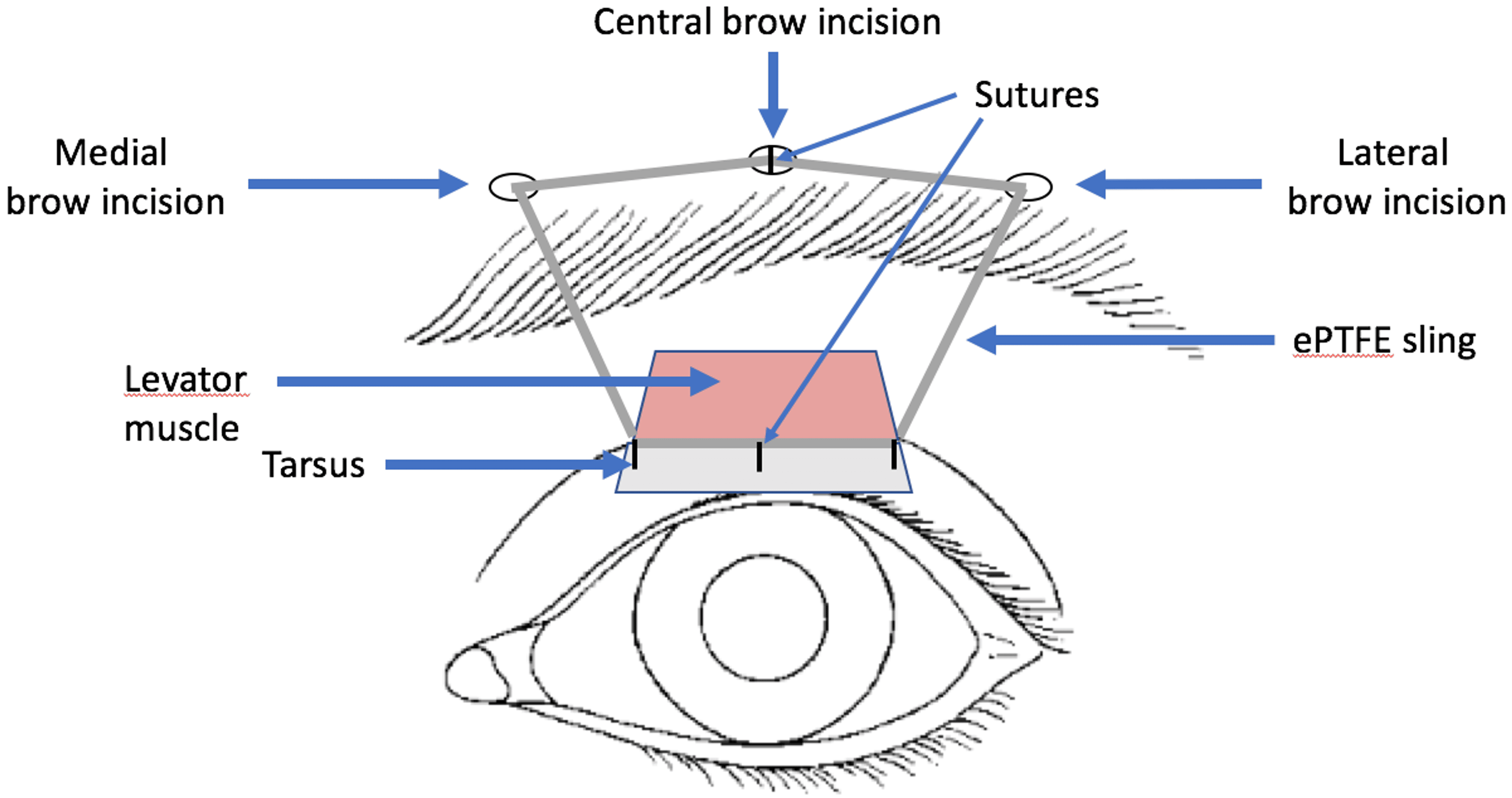 Cureus Surgical After Frontalis Suspension Using Expanded