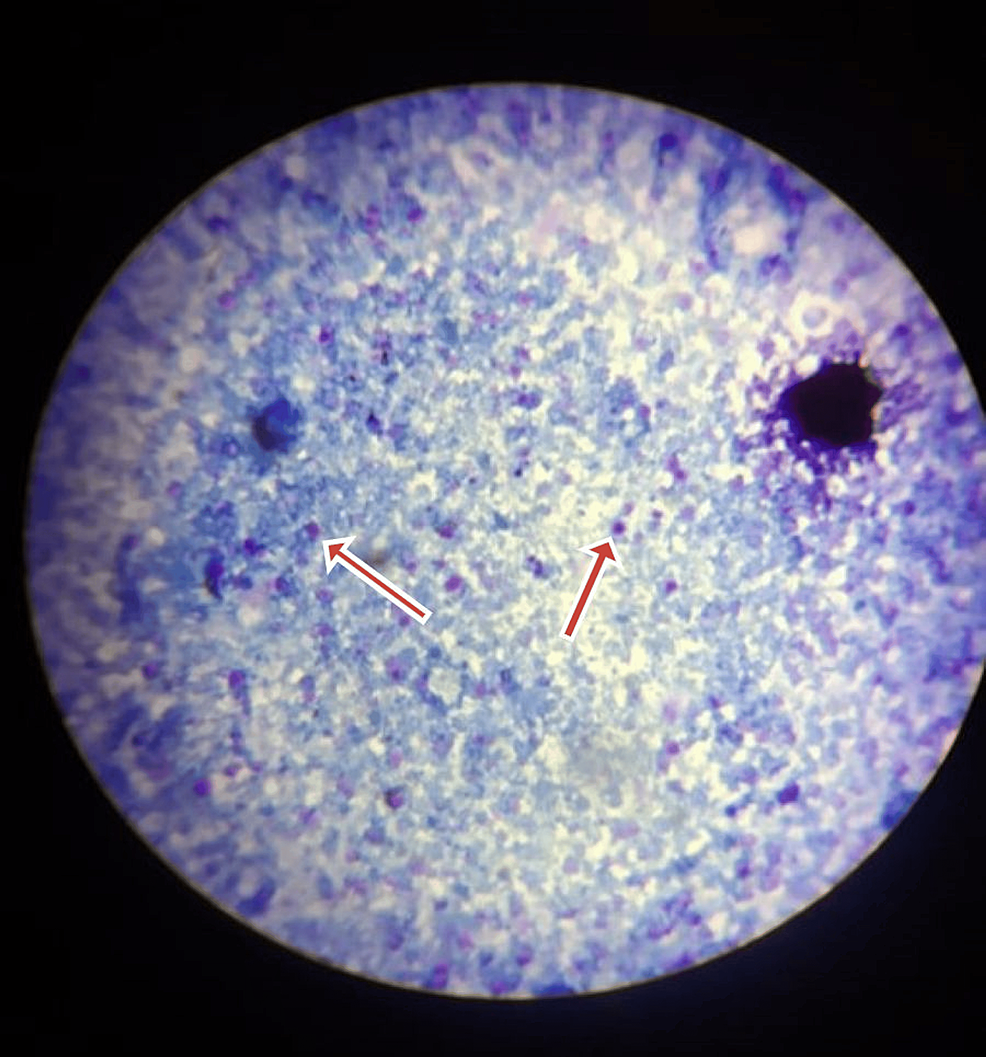 Cryptosporidium Diarrhea in a Patient With Class IV Lupus Nephritis on  Cyclophosphamide: An Underreported Case | Cureus
