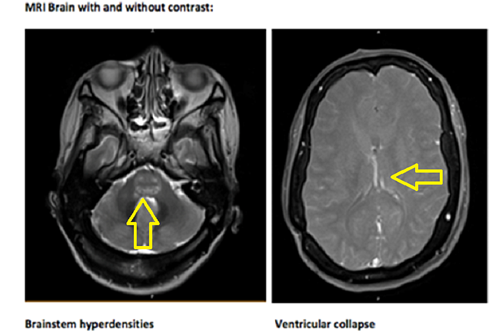 MRI-Brain-