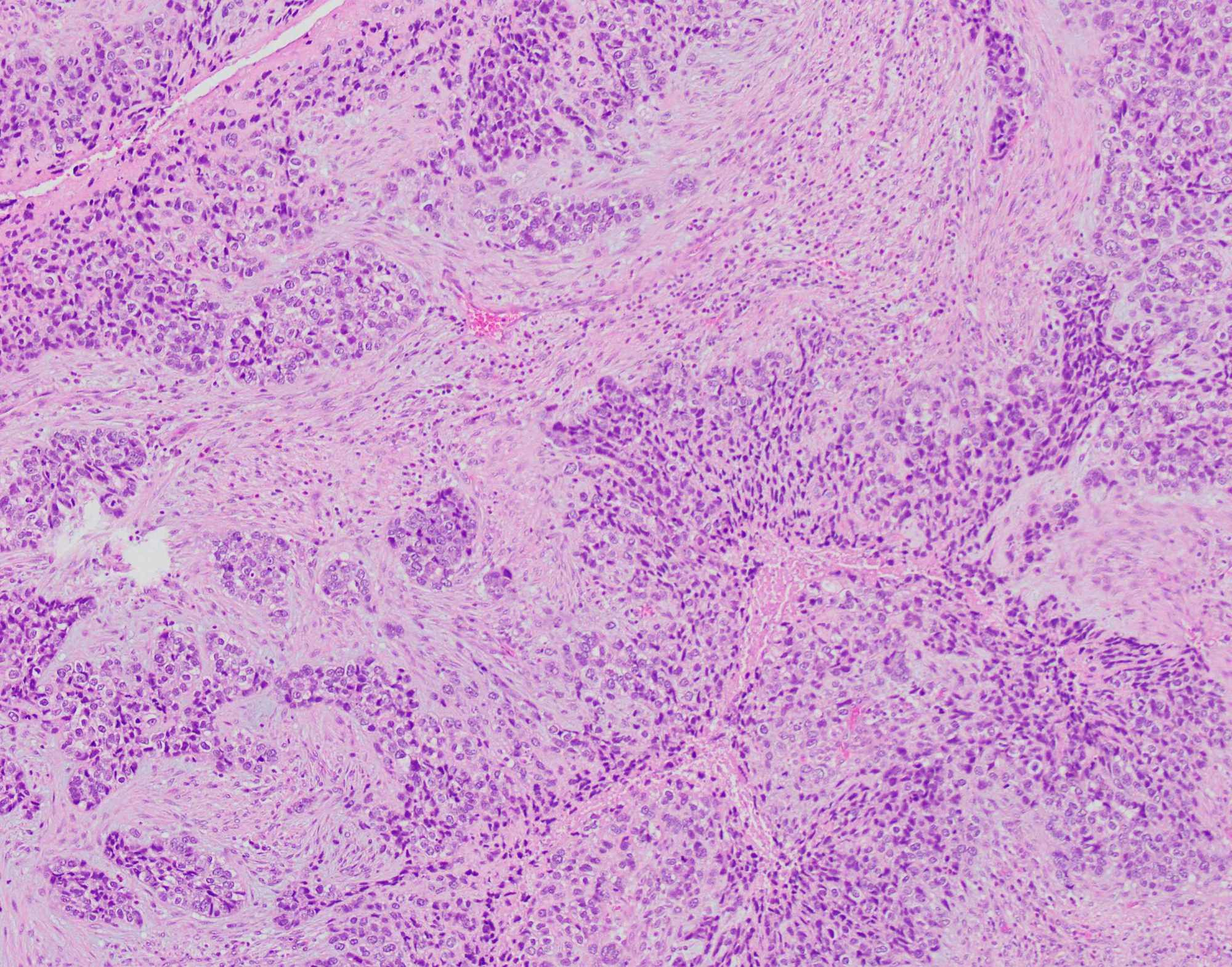 malignant mesothelioma lymph node metastasis