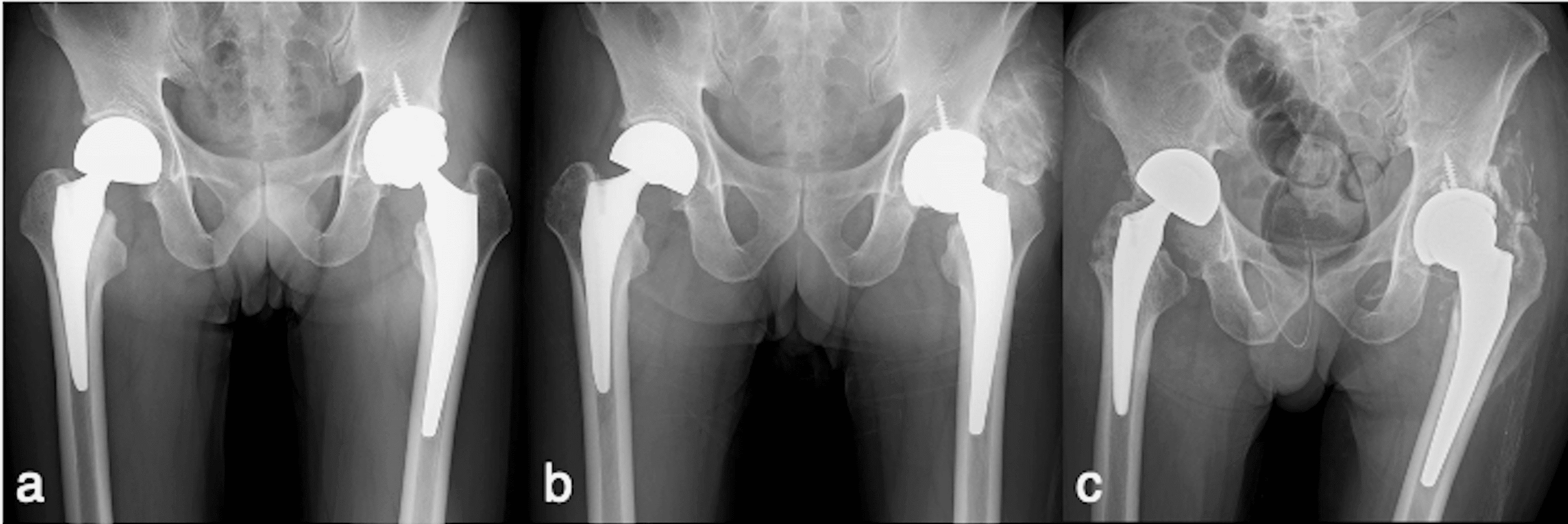 Trunnionosis In Metal On Polyethylene Total Hip Arthroplasty With Periprosthetic Infection A 2690