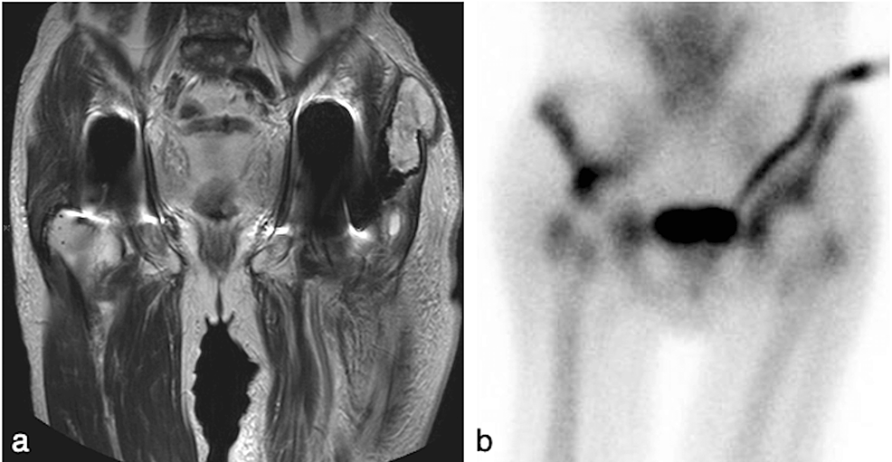 Trunnionosis in MetalonPolyethylene Total Hip Arthroplasty With