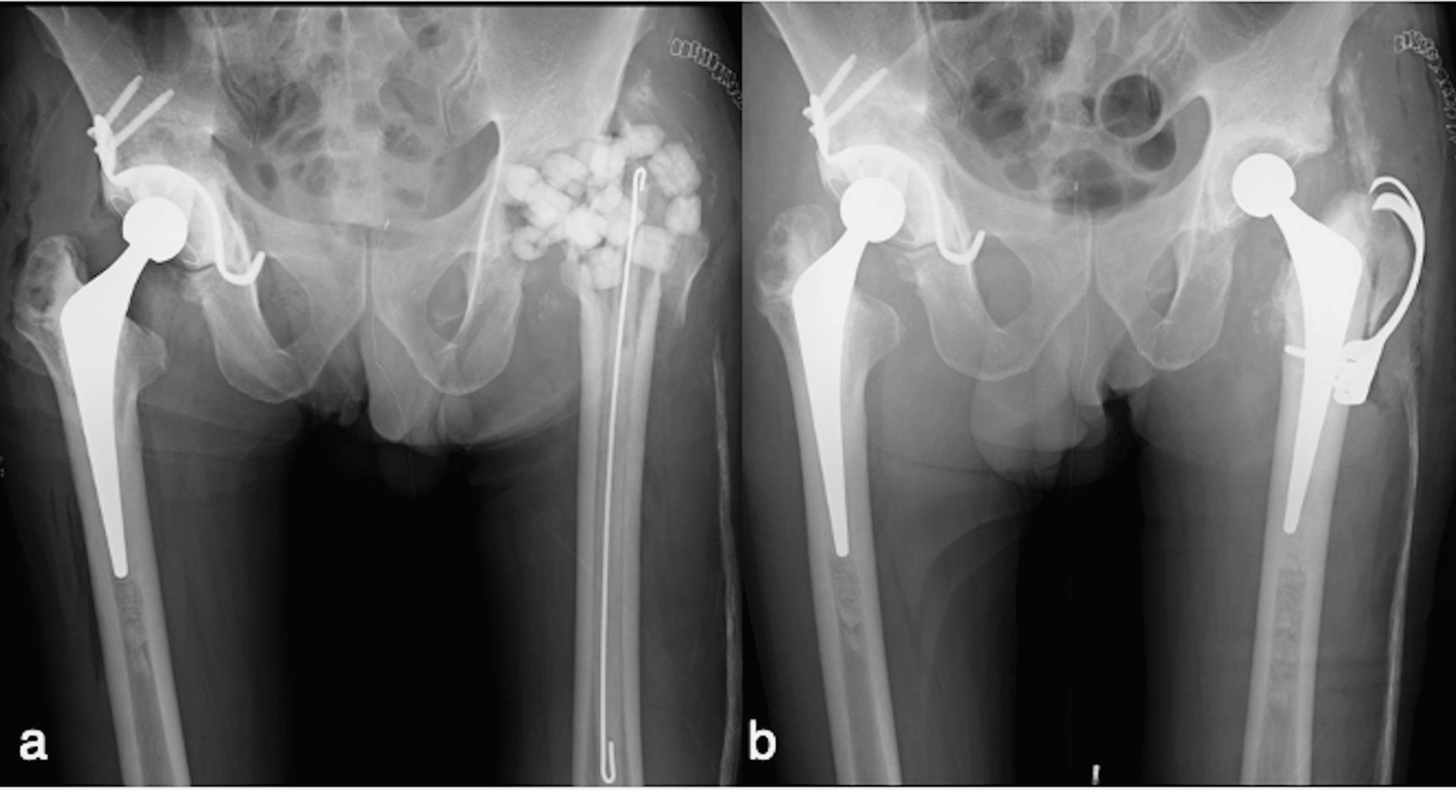 Cureus Trunnionosis in MetalonPolyethylene Total Hip Arthroplasty