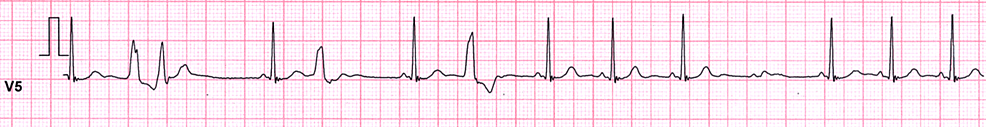 Exercise-Induced Ventricular Tachycardia: A Case Report | Cureus