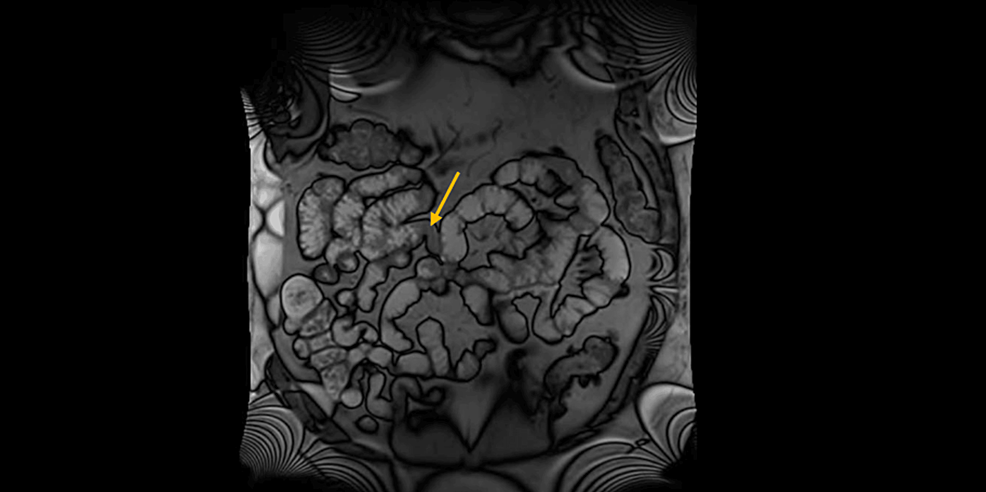 eosinophilic-enteritis-causing-recurrent-small-bowel-obstruction-a