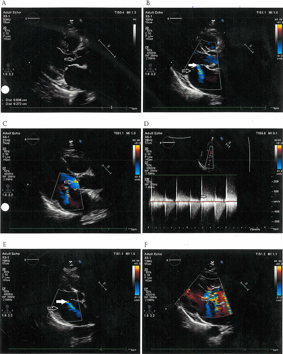 Cureus Infective Endocarditis Masquerading as Rheumatoid