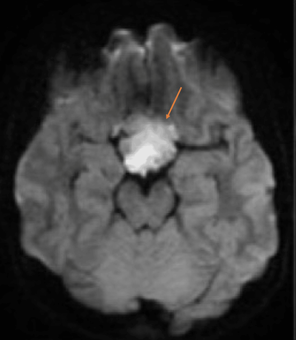 Cureus The Endoscopic Resection Of Sellar And Suprasellar Epidermoid Cyst In A Pediatric 