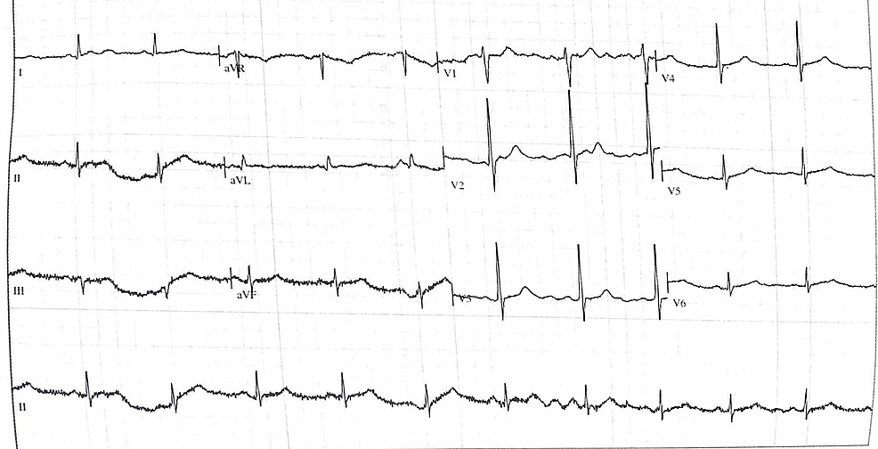 Cureus | Under-diagnosis of Takotsubo Cardiomyopathy Increases Risk of ...