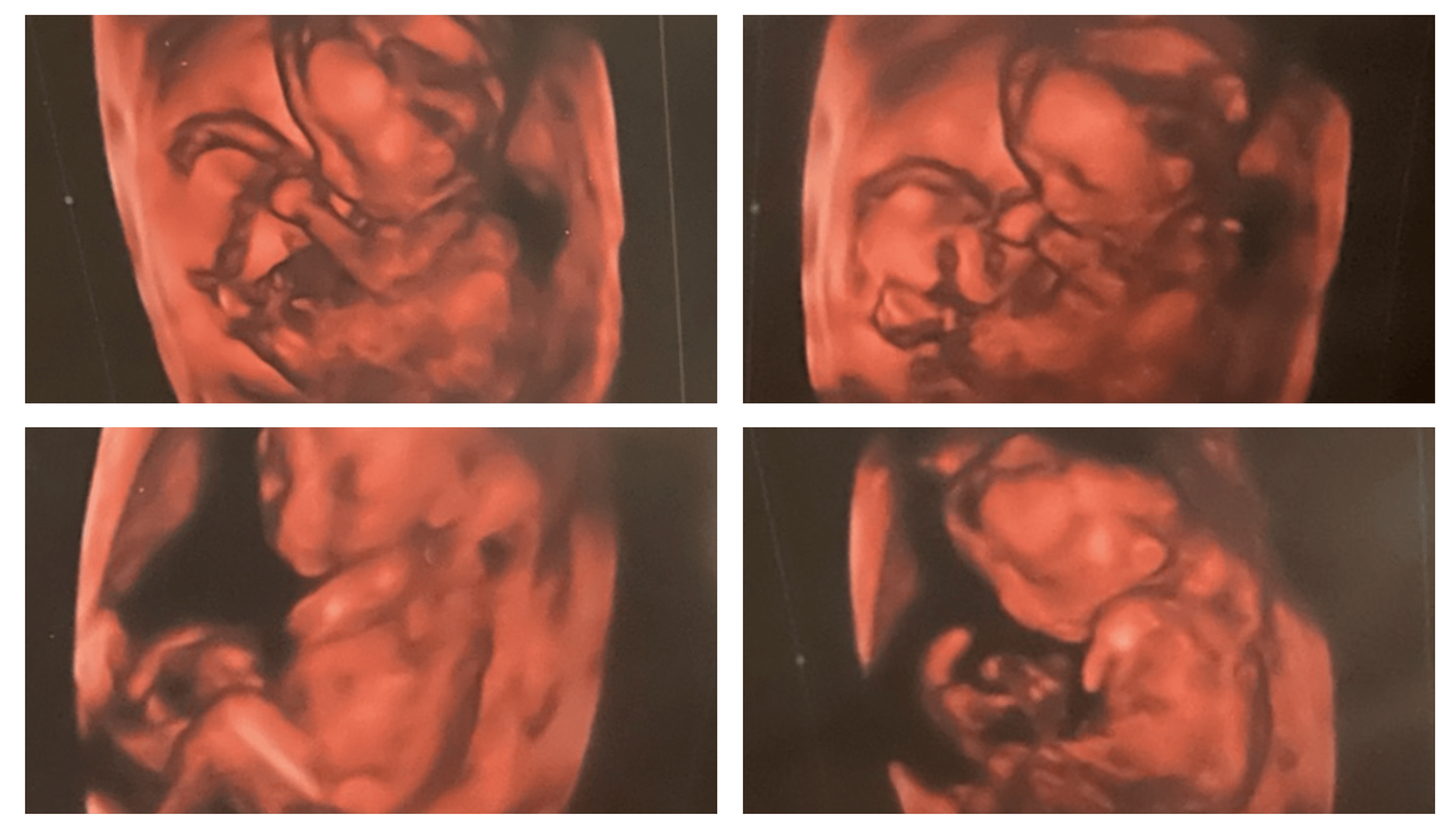 Cureus A LongTerm Survivor of Trisomy 18