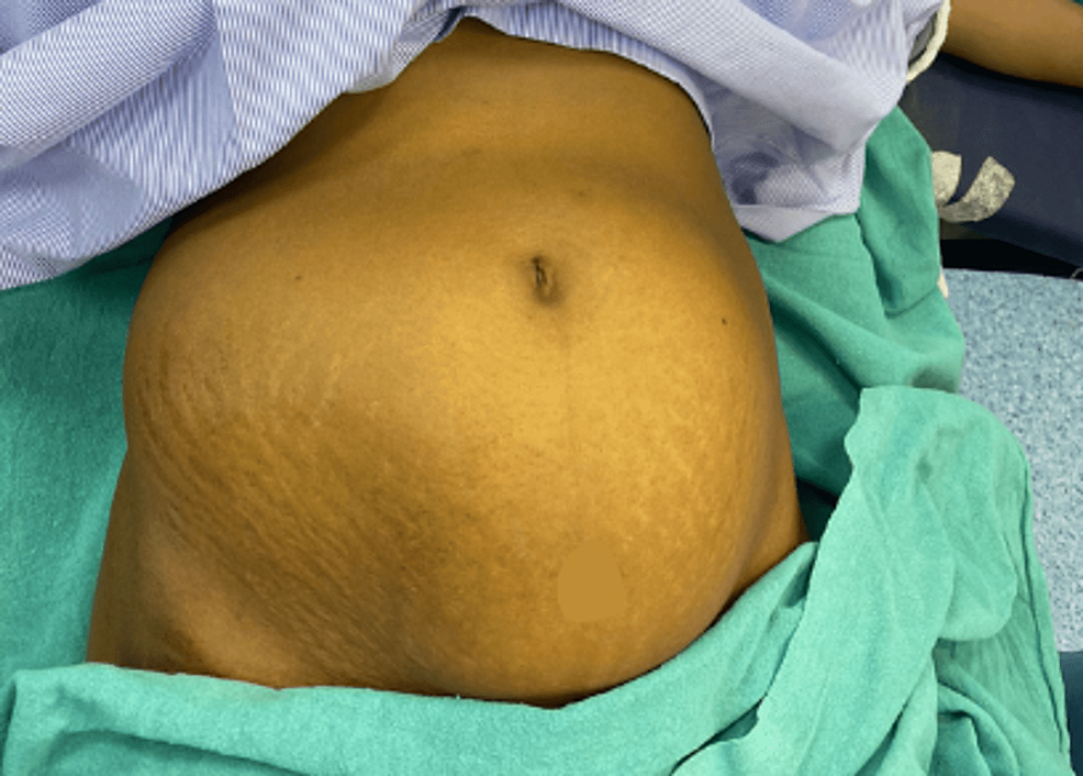 Cureus | Therapeutic Management of Giant Uterine Fibroid: A Case ...