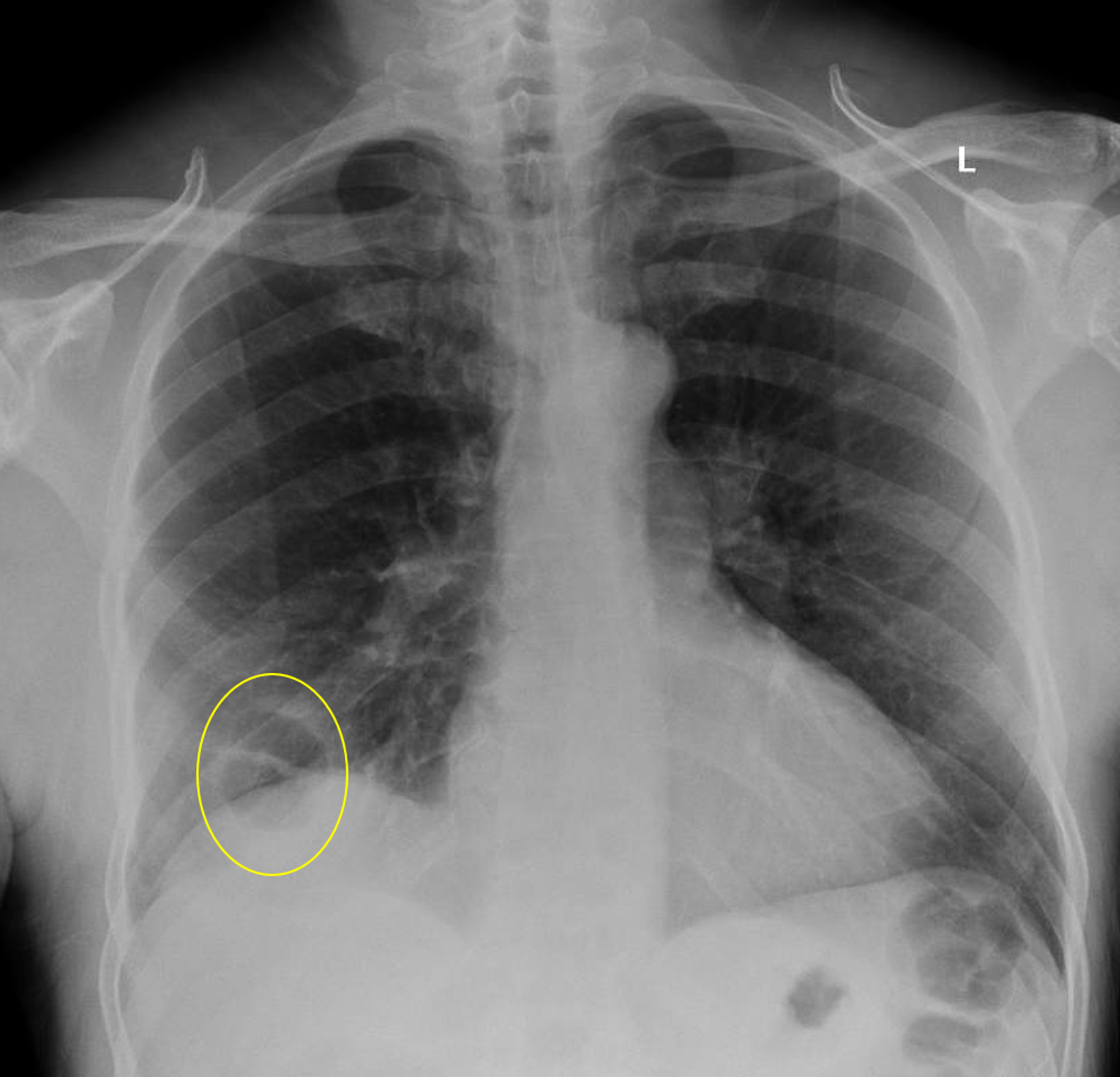 Cureus | Cavitary Pulmonary Infarction In A Case Of Pulmonary Embolism ...