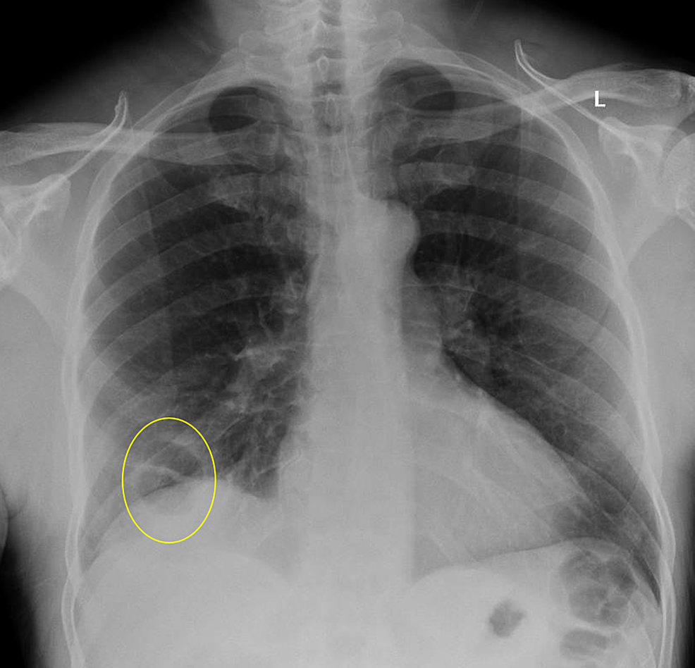 cureus-cavitary-pulmonary-infarction-in-a-case-of-pulmonary-embolism