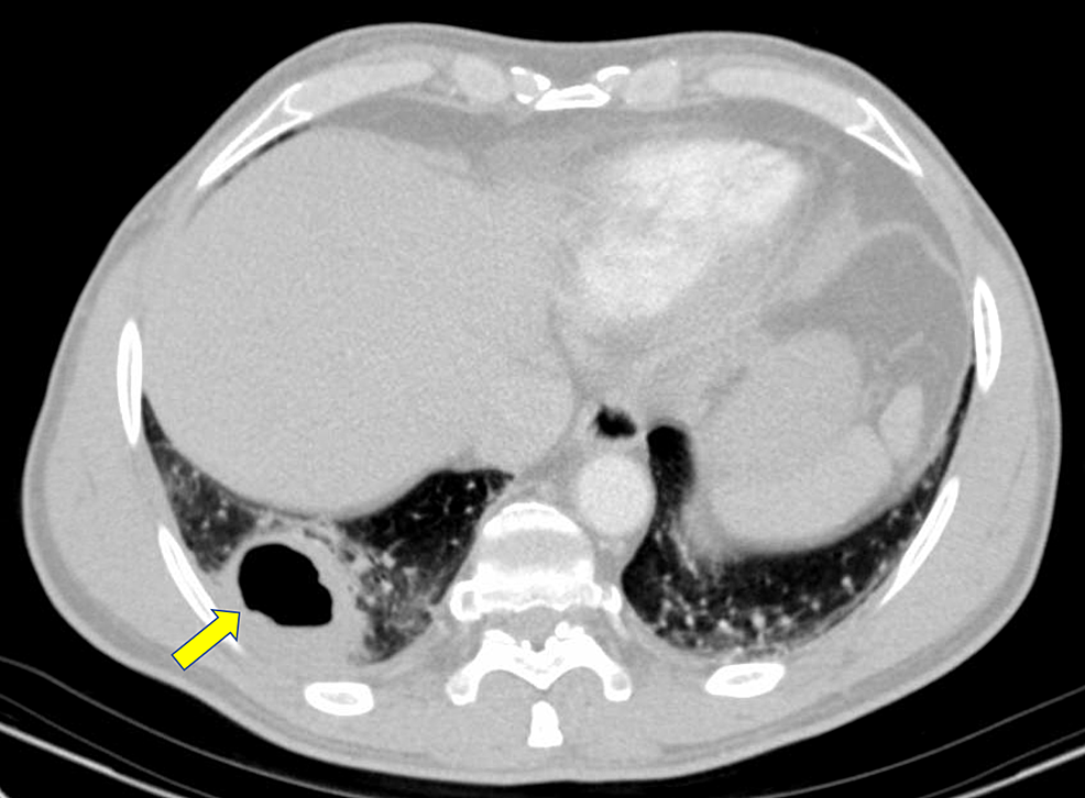 Cureus Cavitary Pulmonary Infarction in a Case of Pulmonary Embolism After Successful Vascular