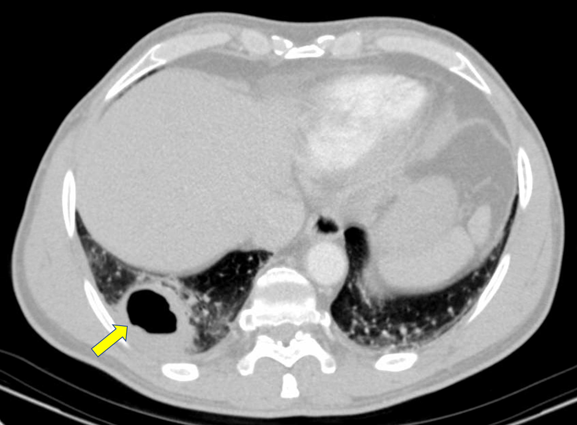 Pulmonary Cavitary And Cystic Lesions Radiology Key - vrogue.co