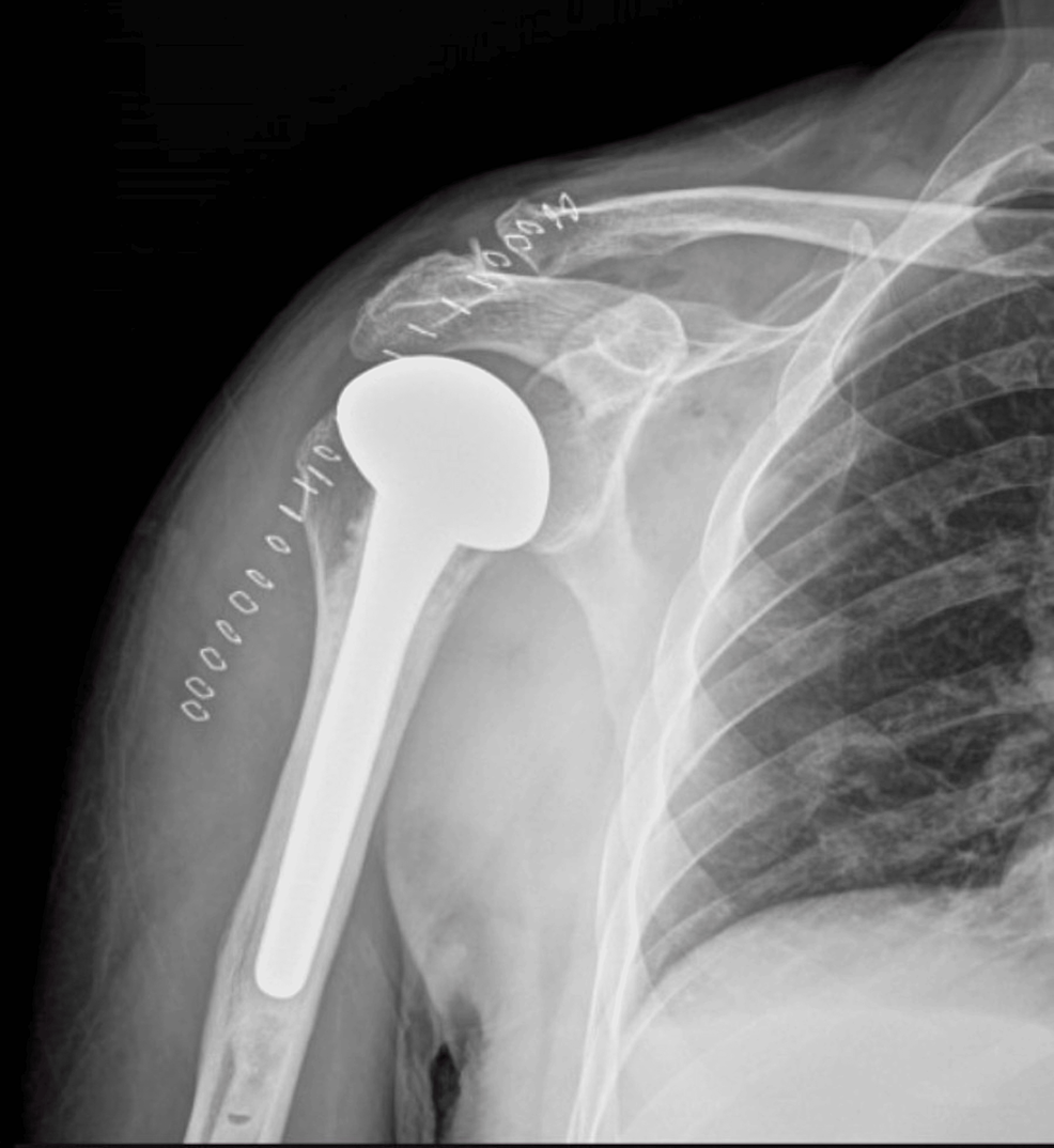 Cureus Posterior Dislocation of the Shoulder The LightBulb Sign