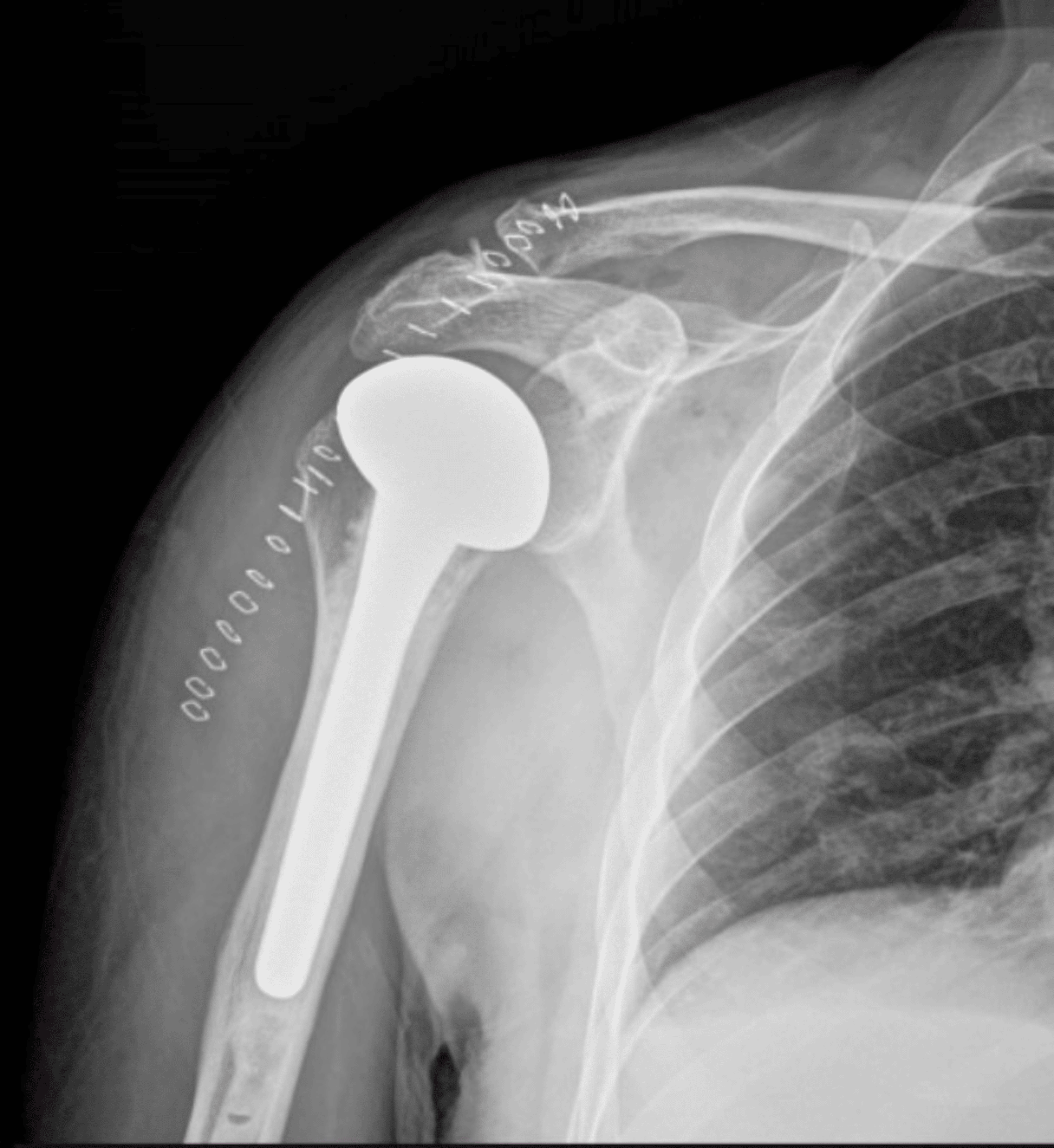 Posterior Dislocation of the Shoulder The LightBulb Sign Cureus