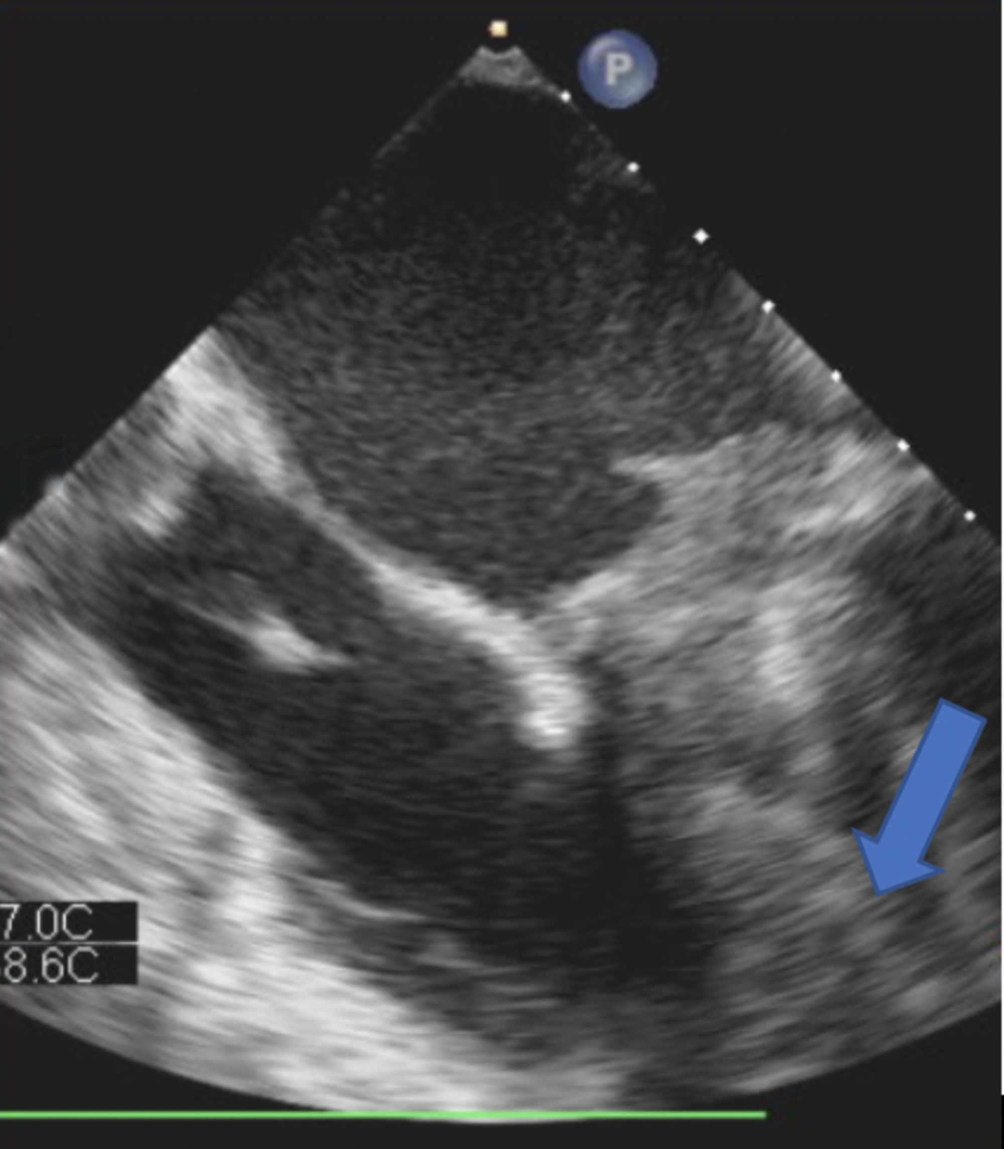 Cureus Mechanical Valve Thrombosis in a Pregnant Patient A Case of