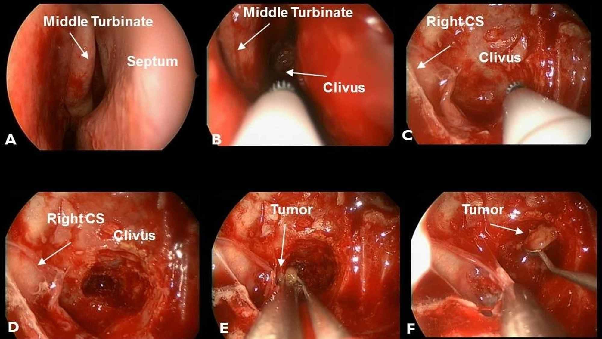 Cureus Metastatic Disease To Clivus Biopsy Or Not