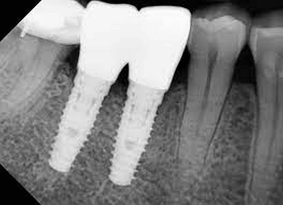 The Impact Of Implant Angulation On The Stress Distribution And ...