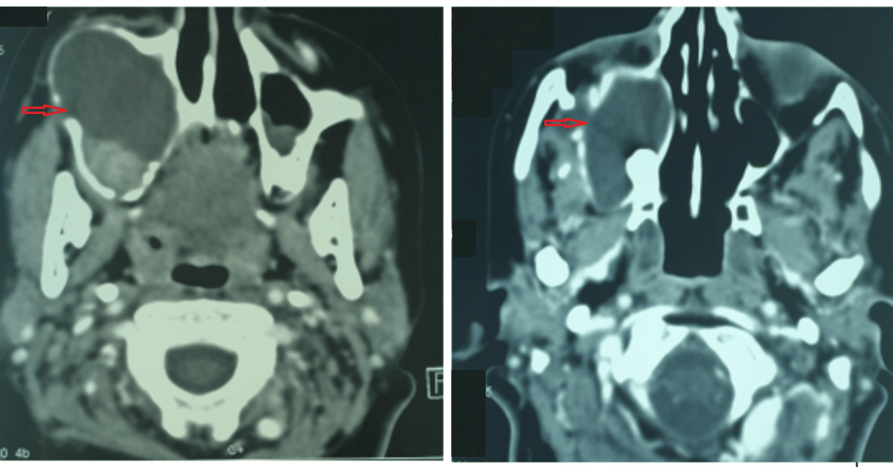 Cureus Maxillary Sinus Ameloblastoma in Turner Syndrome A