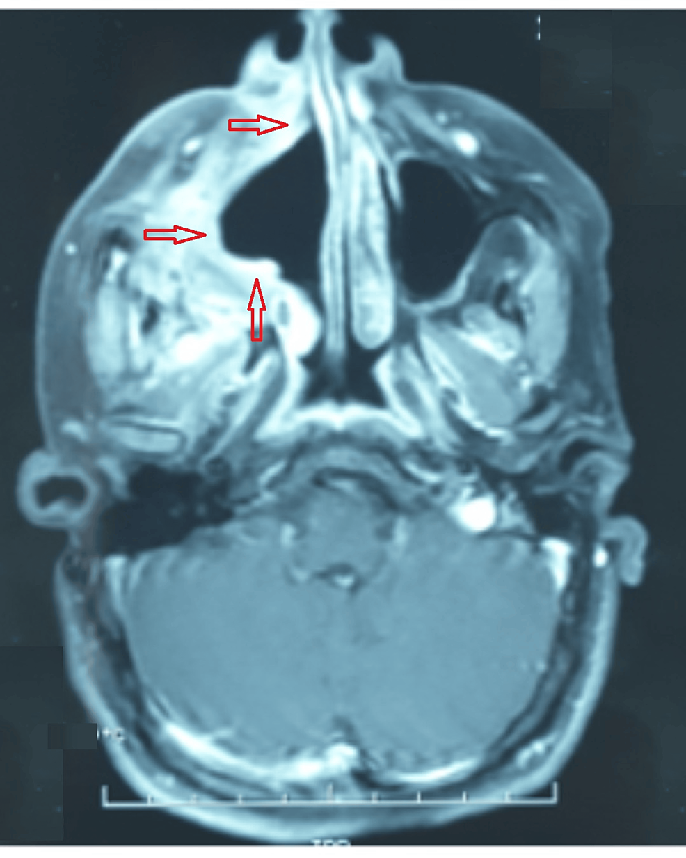 Cureus Maxillary Sinus Ameloblastoma in Turner Syndrome A