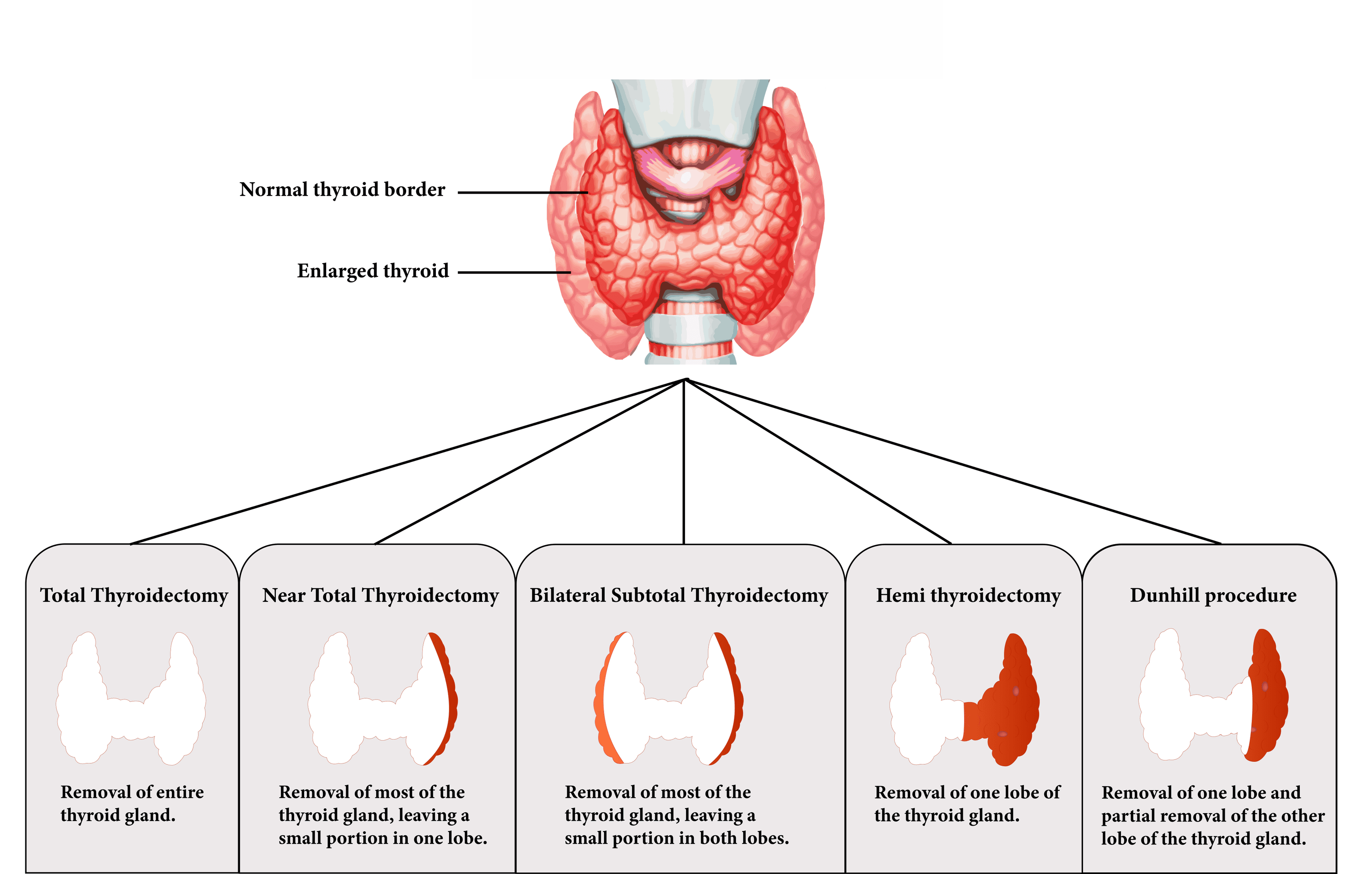 Advancing Preoperative Strategies for Thyroidectomy in Graves’ Disease