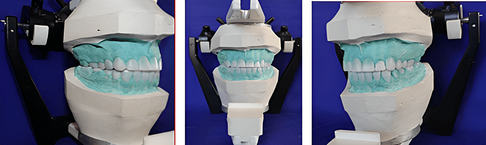 Cureus | pankey mann schuyler philosophy-based prosthetic
