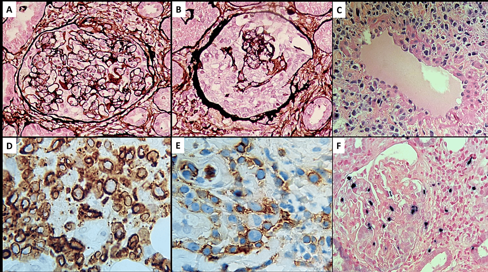 Cureus A Case of Extranodal NK/Tcell Lymphoma Infiltrating Kidneys