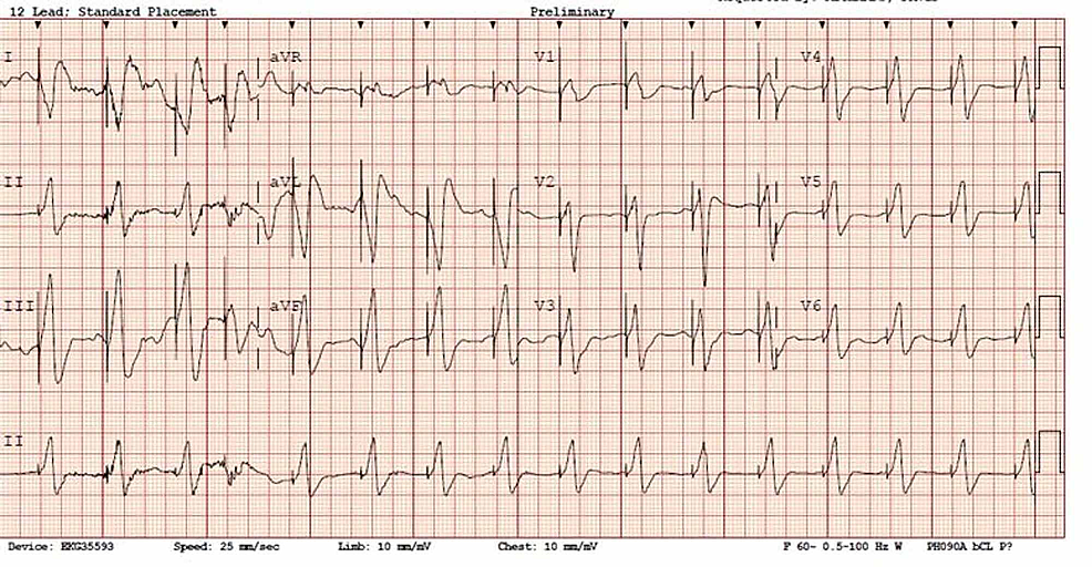 Cureus Digoxin Toxicity in a Patient with Pacemaker A Case Report