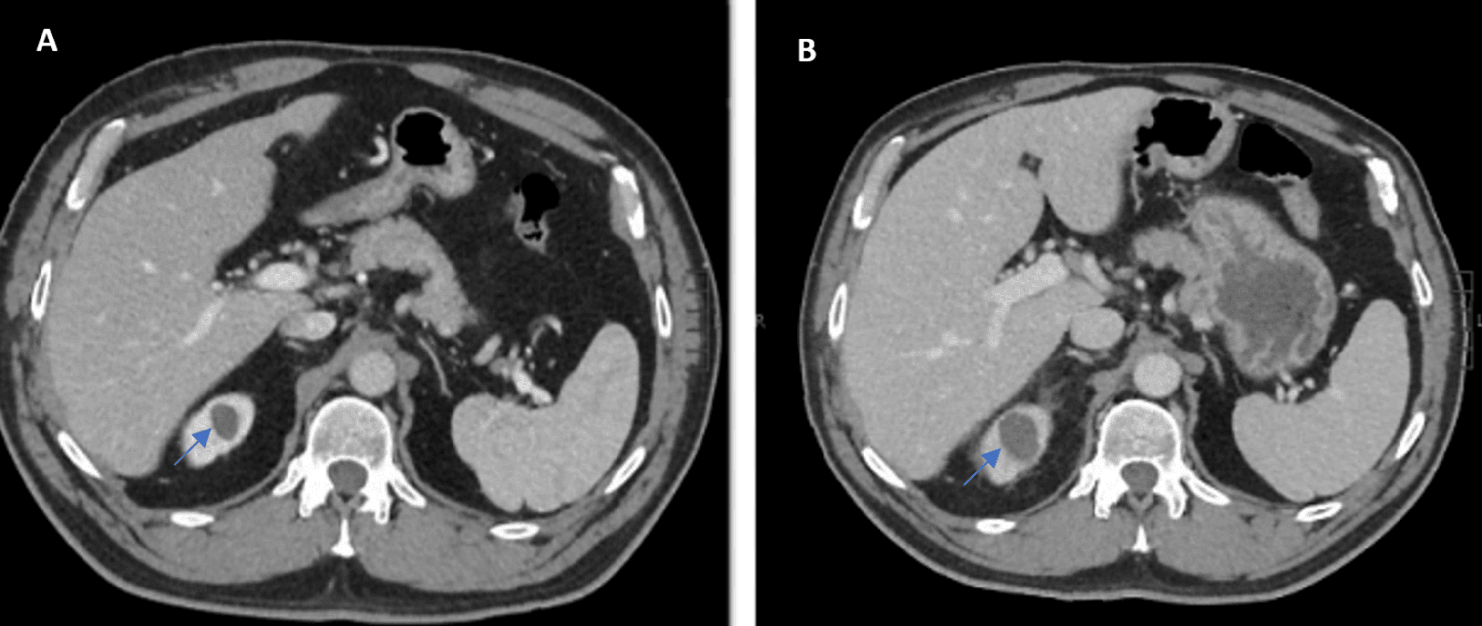 Cureus A Unique Presentation of an Infected Renal Cyst A Case Report