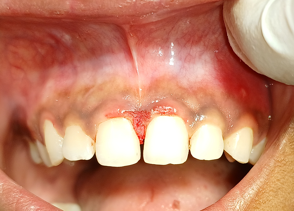Conventional Scalpel and Diode Laser Approach for the Management of