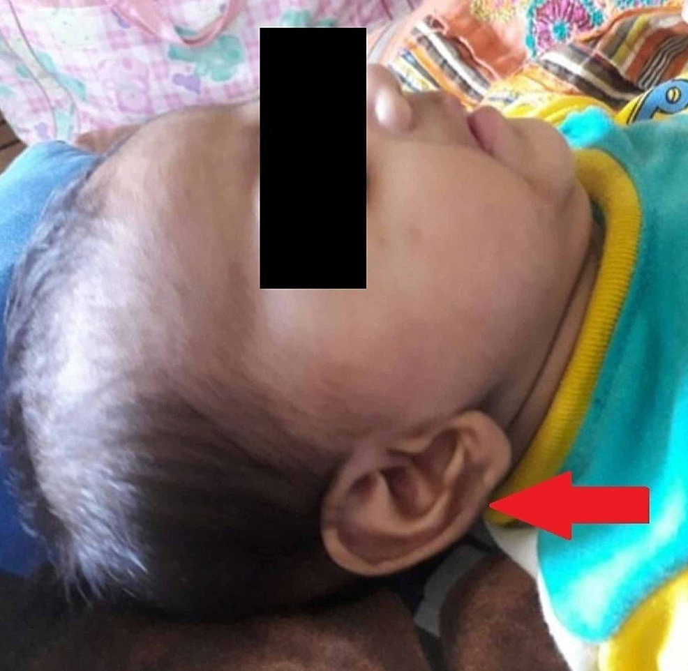 Hypertrichosis-with-low-set-ears.