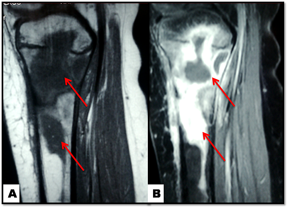 Cureus Salmonella Osteomyelitis of the Proximal Tibia in a Previously