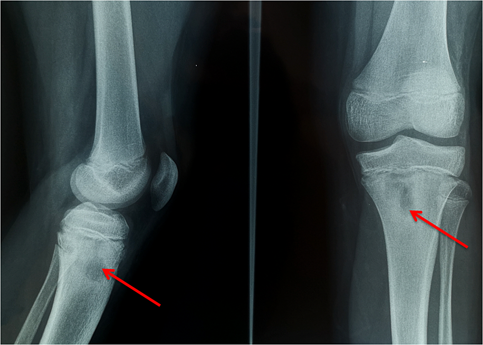 Cureus Salmonella Osteomyelitis of the Proximal Tibia in a Previously