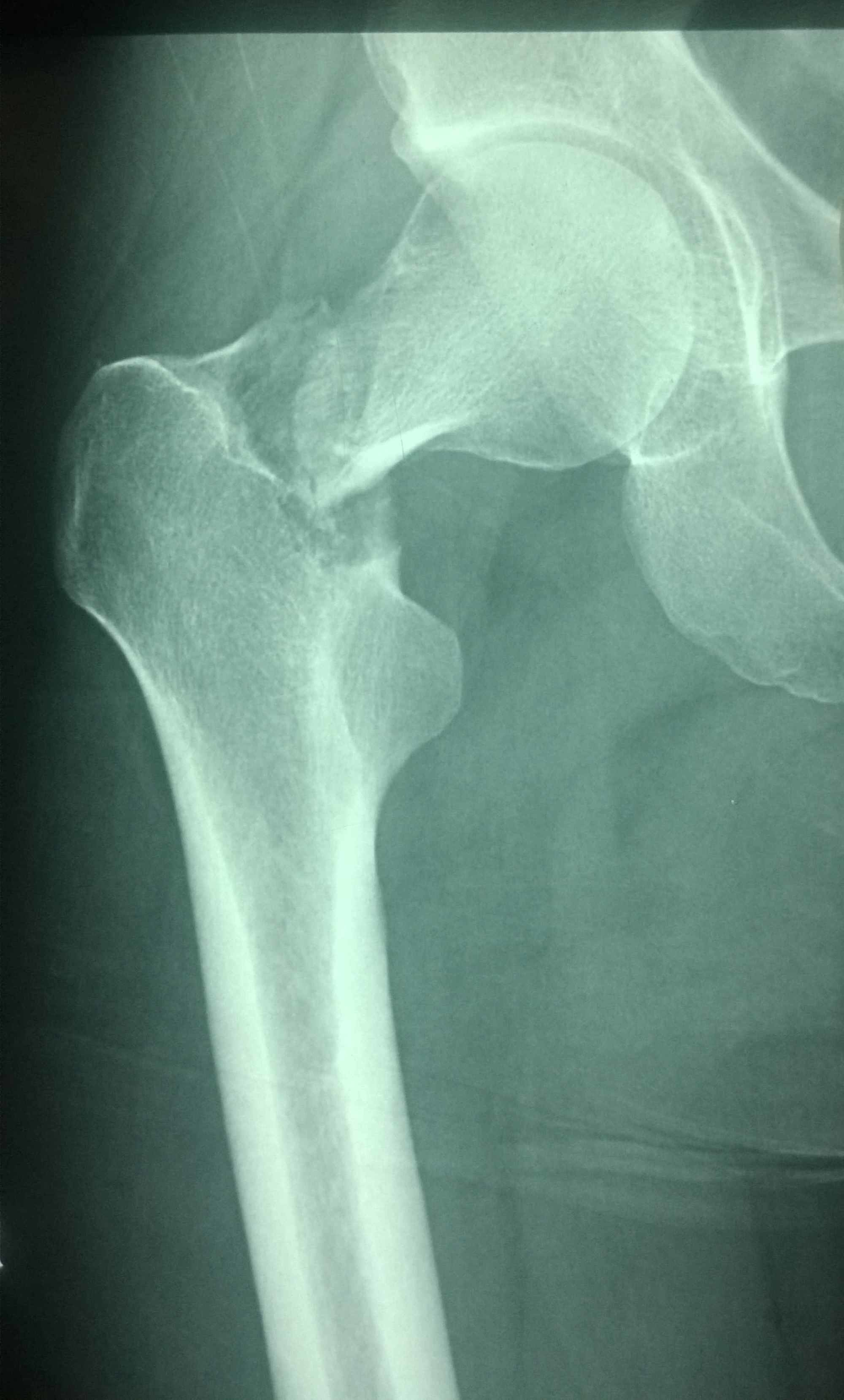 Femoral neck fracture x ray - foliowery
