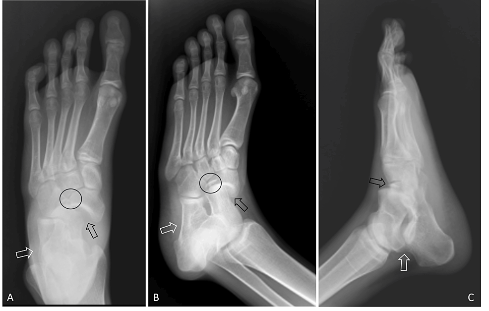 Foot X-ray of a 10 year-old male patient (white arrow indicates fracture).