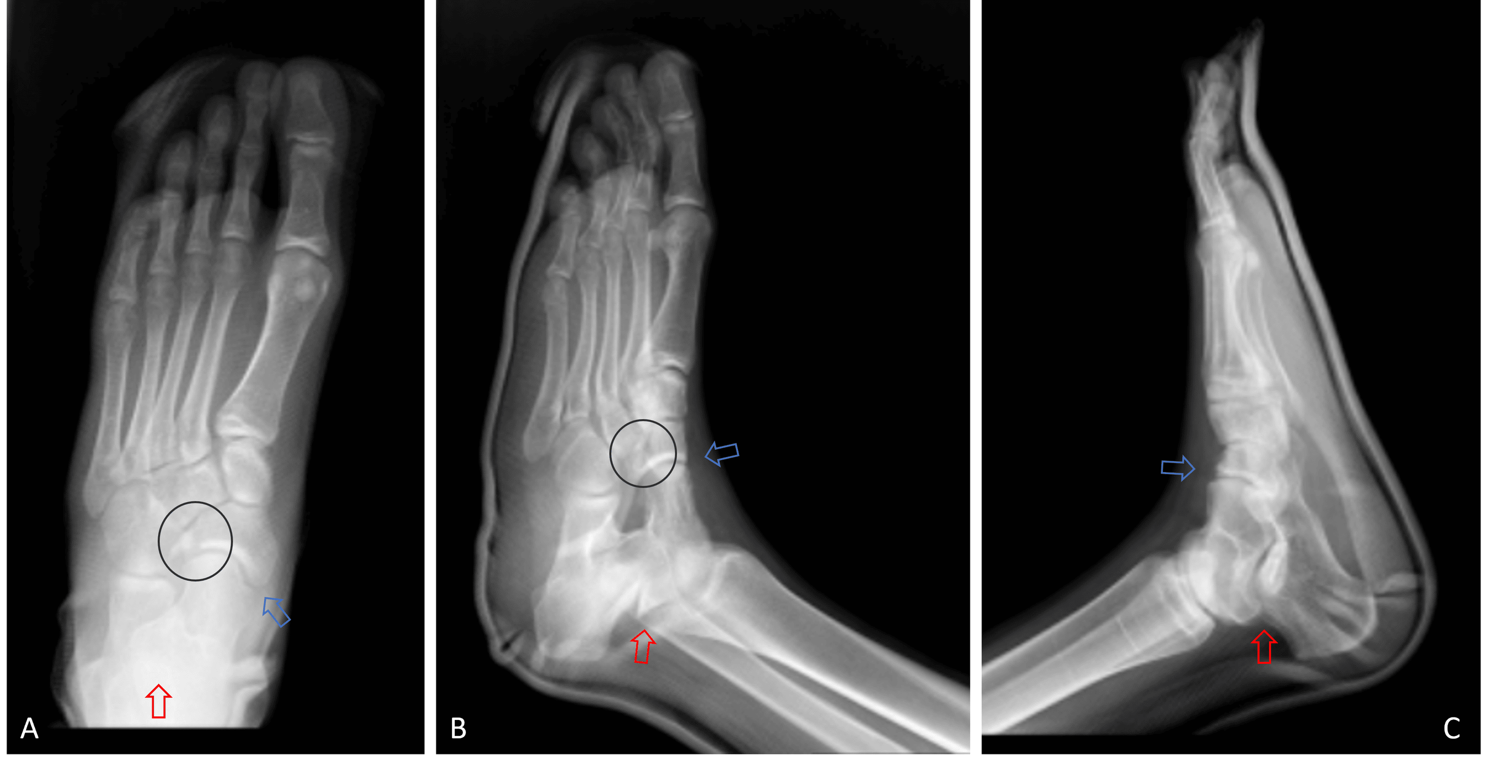 Cureus Simultaneous Talocalcaneal and Talonavicular Joint Dislocation