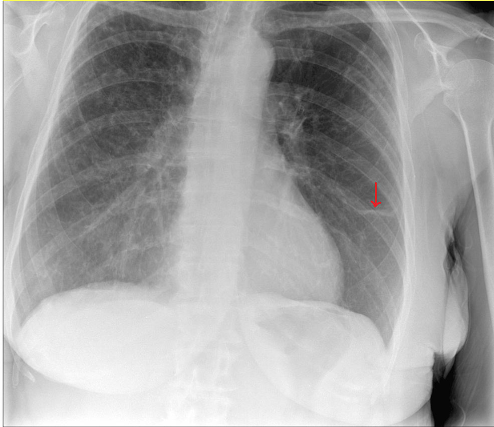 Cureus | Hemoptysis of Uncertain Cause Leading to Delayed Diagnosis in ...