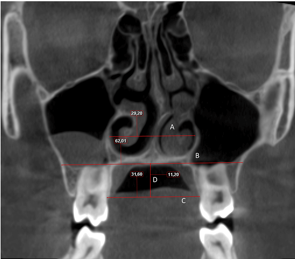 Cureus | is there a relationship between unilateral/bilateral impacted