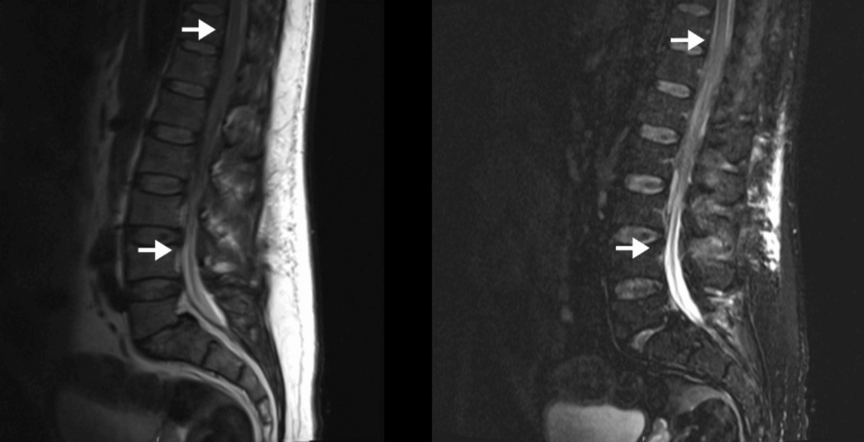 Infected Spinal Hematoma After Accidental Exteriorization of an