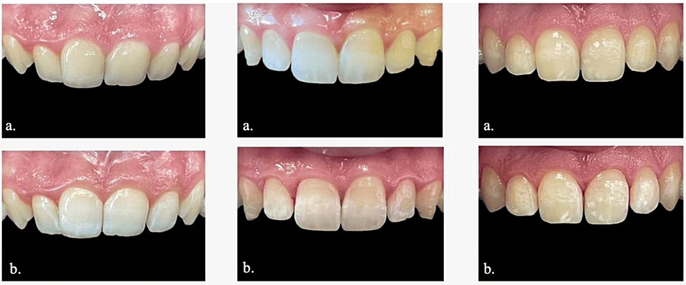 Cureus | the effect of dehydration on tooth color: a prospective in