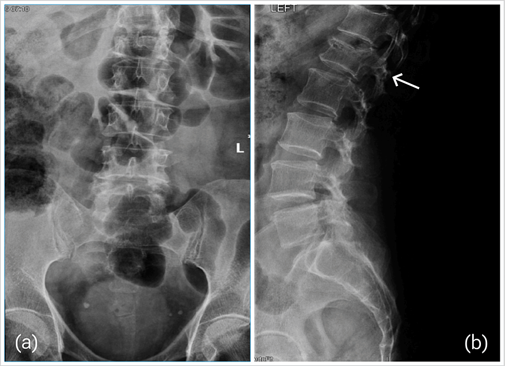 Compression fracture, Radiology Case