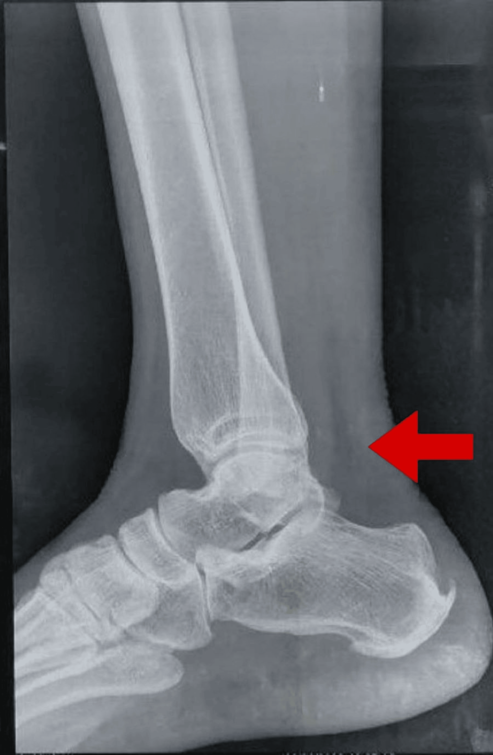 How long does it take for Achilles tendonitis to heal? (updated 2024!) —  Base Camp Chiropractic & Sports Rehab