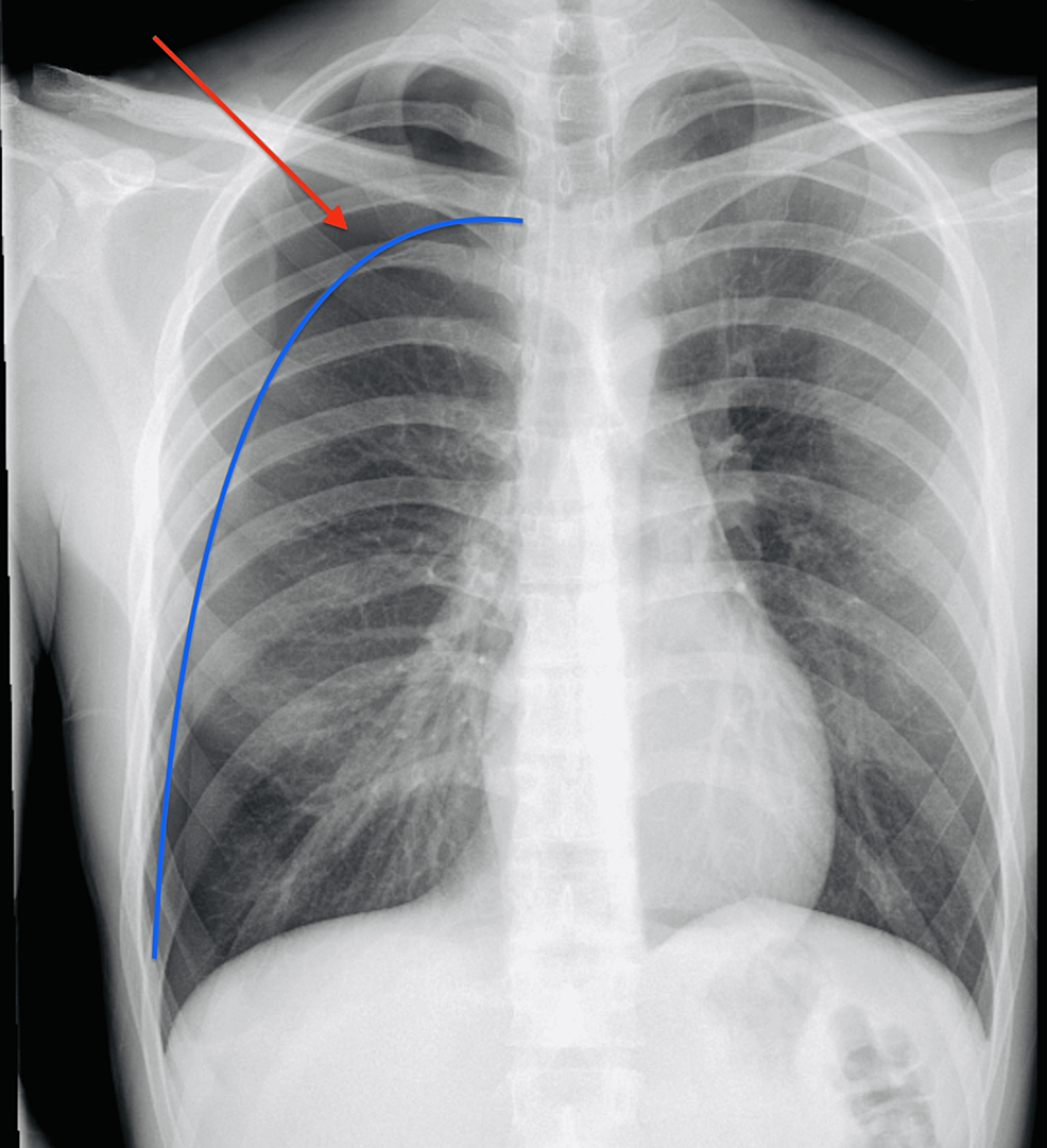 Cannabis-Associated Pneumothorax: A Case Report