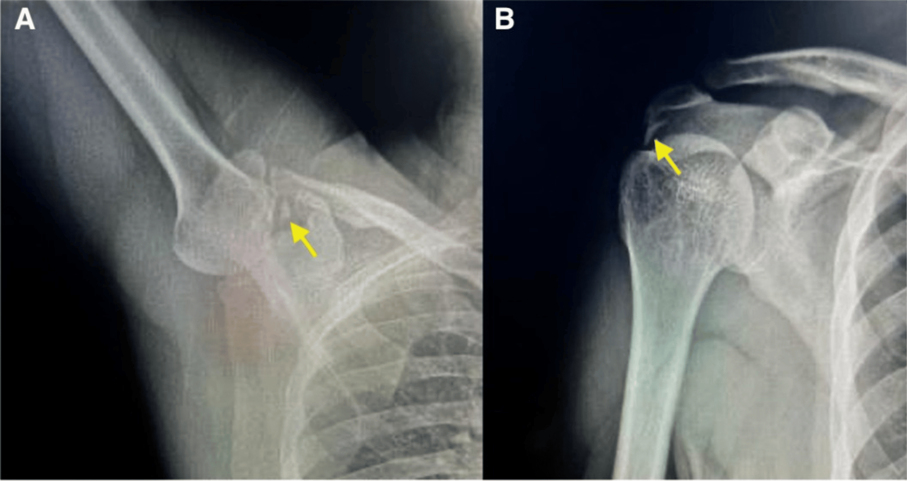 An Unusual Presentation Of Subscapularis Tendon Calcific Tendonitis ...